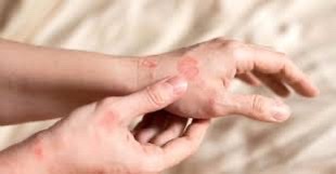 Pokrzywka spontaniczna